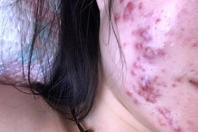 严重痤疮囊肿结节图