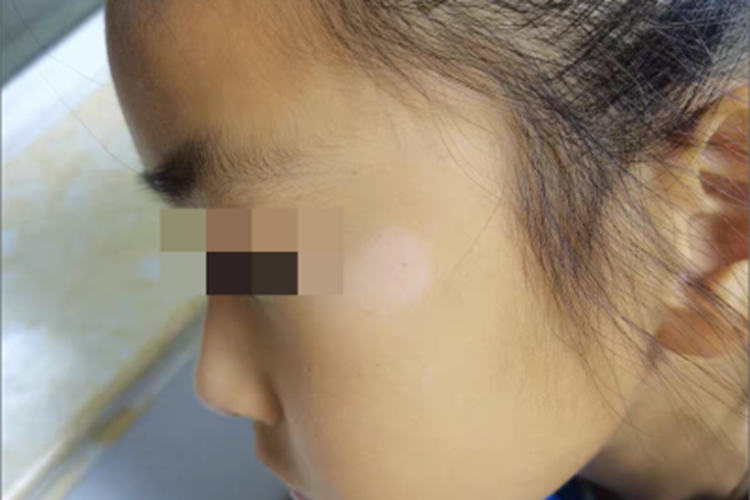 混合型白癜风面部斑图 混合型白癜风面部斑图