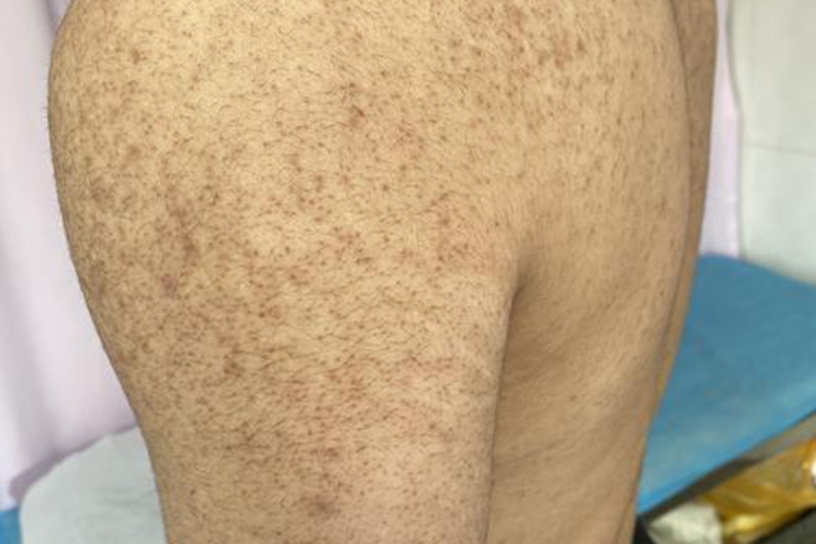 肩胛严重毛周角化病图 肩胛严重毛周角化病图