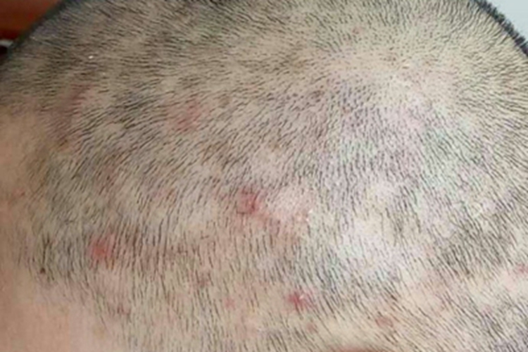 秃发性毛囊炎头皮红斑图 秃发性毛囊炎头皮红斑图