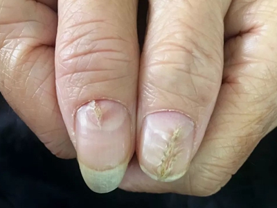 女性手指甲断裂分层图片