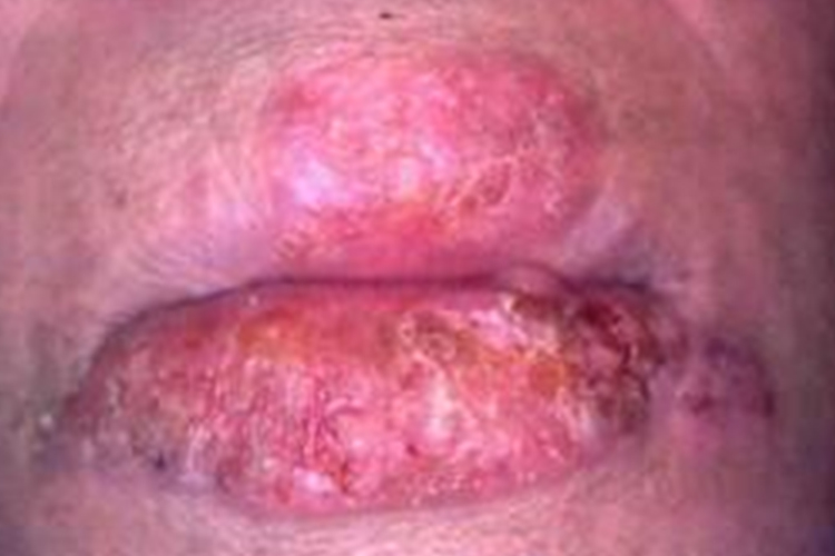 光化性唇炎图