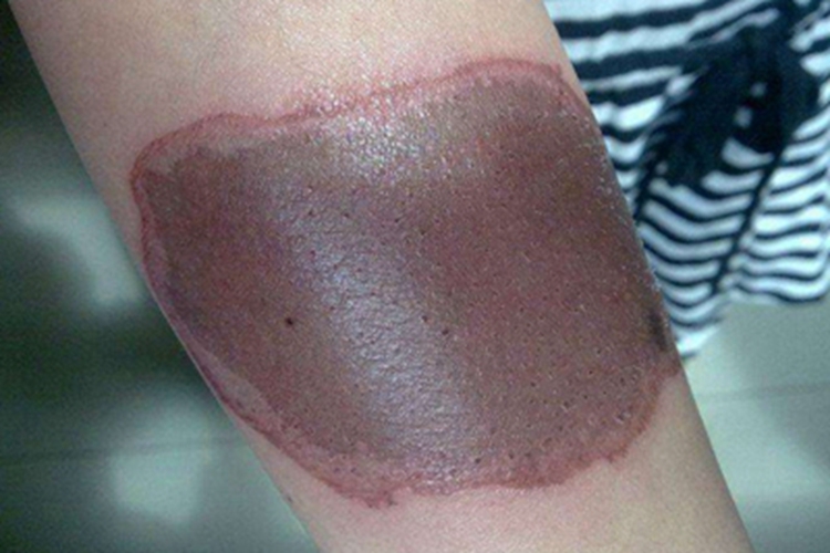 Ⅰ度烧伤皮肤发紫图