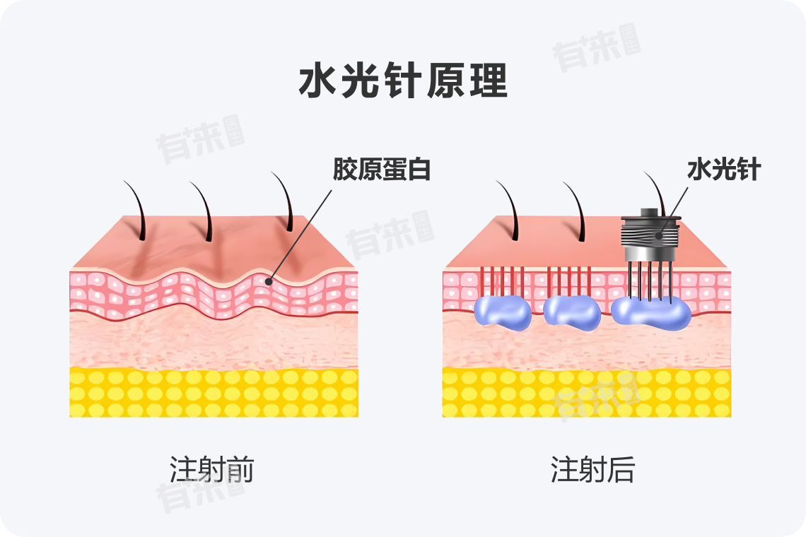 舒敏之星和水光针可以一起做吗-有来医生