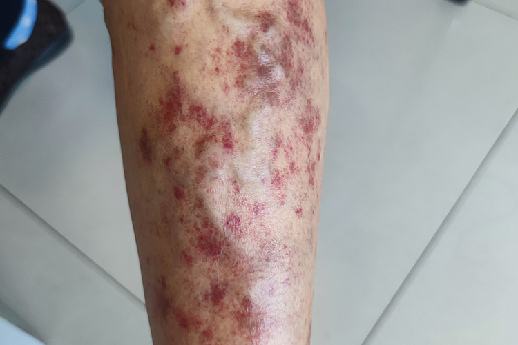 脚部亚急性湿疹图 脚部亚急性湿疹图