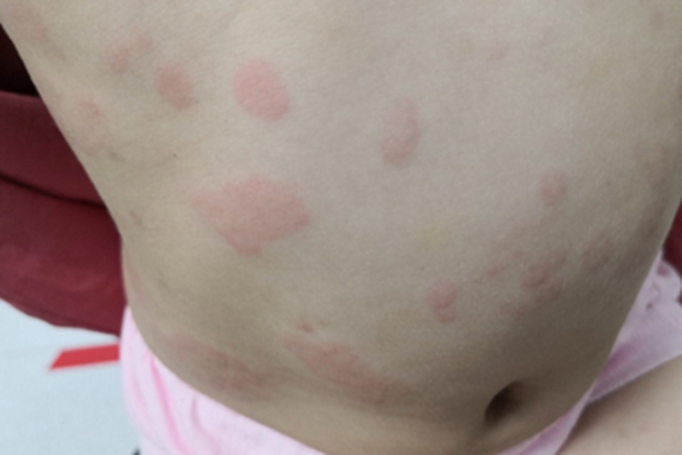 感染性荨麻疹腹部症状图