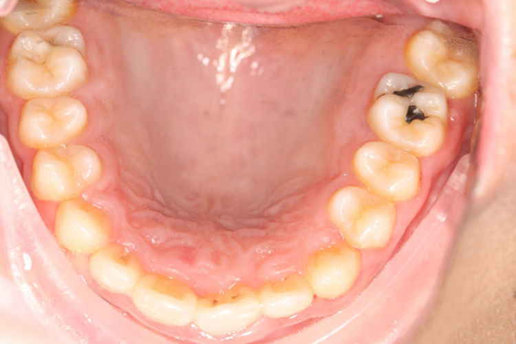 扭转牙正畸后图