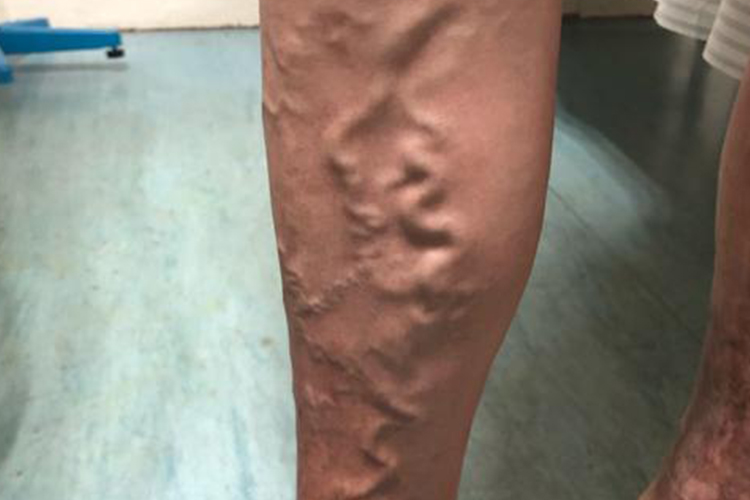 下肢静脉弯曲、扩张图