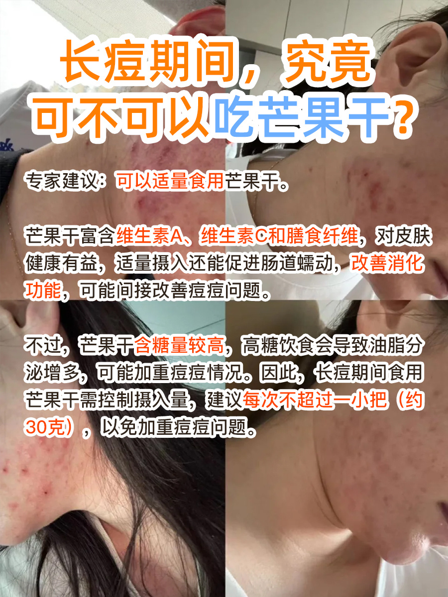 长痘也能吃芒果干?专家来解答!