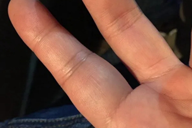 扭伤手部症状图