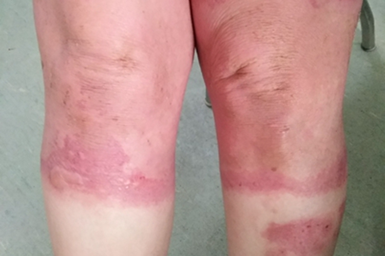 急性接触性皮炎小腿红斑水疱图