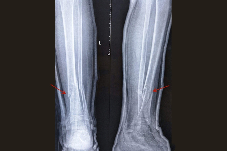 胫骨骨折迟缓愈合图 胫骨骨折迟缓愈合图