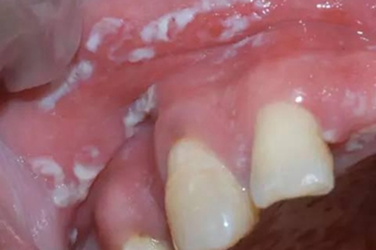 念珠菌性口炎牙龈白斑图 念珠菌性口炎牙龈白斑图