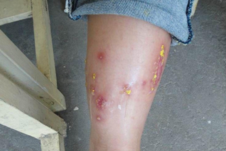 自身敏感性皮炎小腿症状图