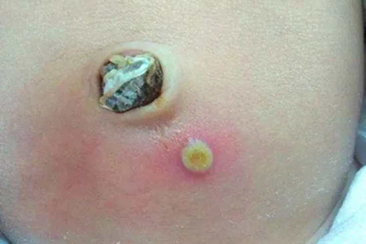 新生儿脓疱疮腹部脓包图