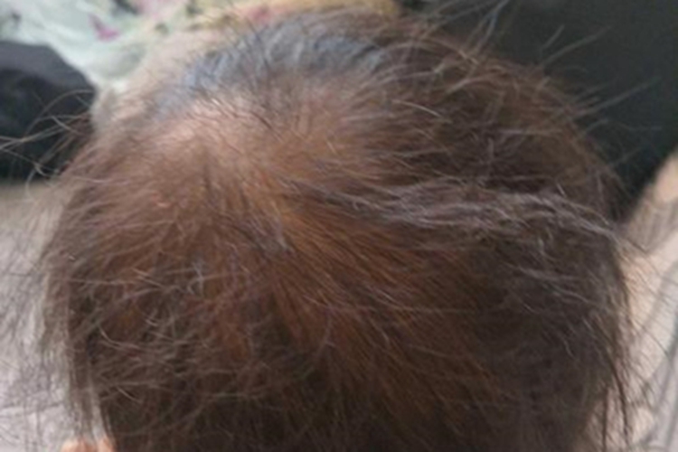 少毛症头发细软稀少图 少毛症头发细软稀少图