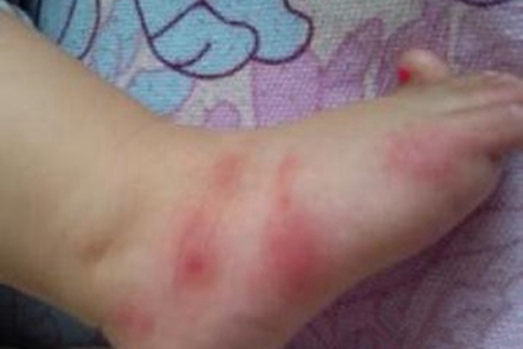 蚊虫叮咬脚背很多红斑图 蚊虫叮咬脚背很多红斑图