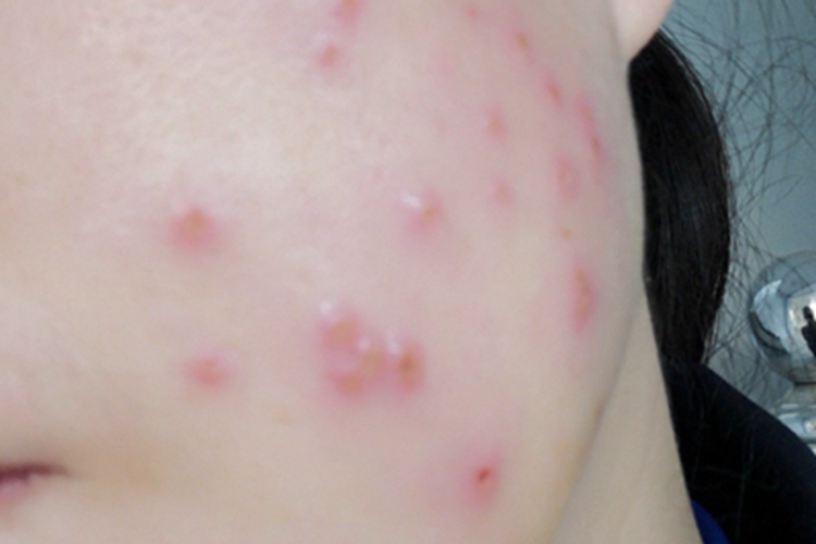 疱疹样湿疹脸上长疱图 疱疹样湿疹脸上长疱图