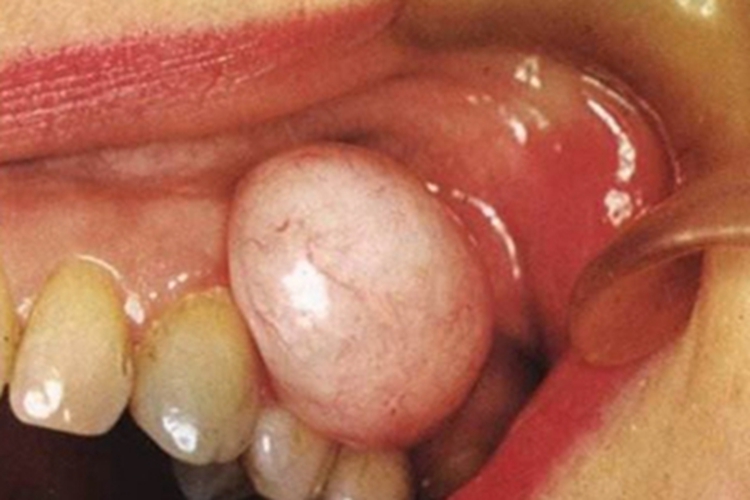 牙龈瘤牙龈上长大包图