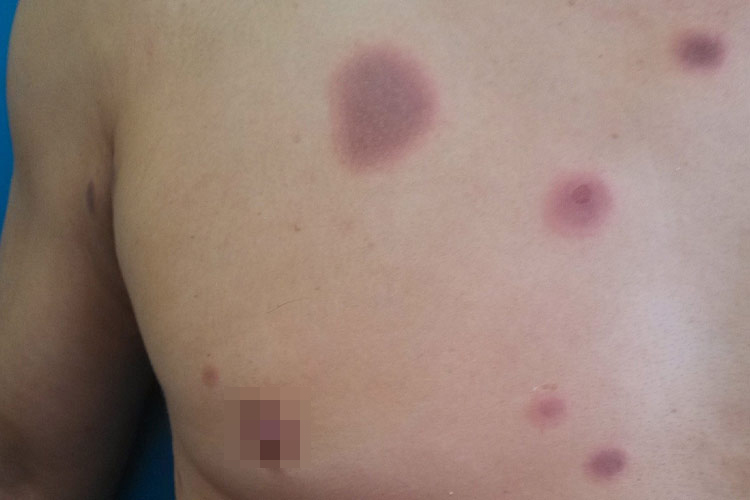 甲钴胺片过敏固定性红斑图