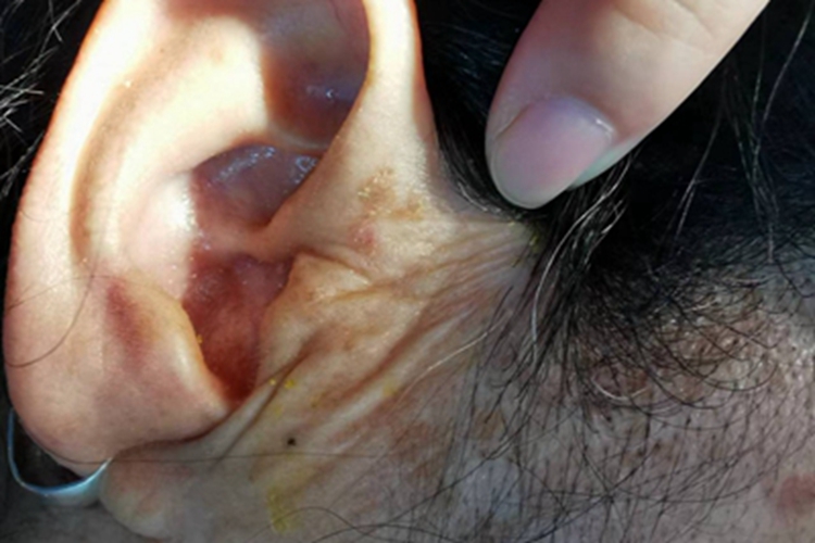 扁平疣耳朵周围有褐色斑块图