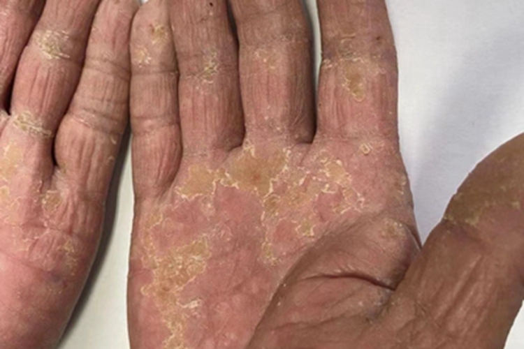 砷角化病手掌脱屑图