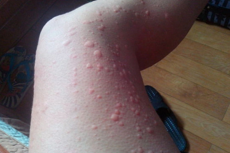 腿部大小不等风团图