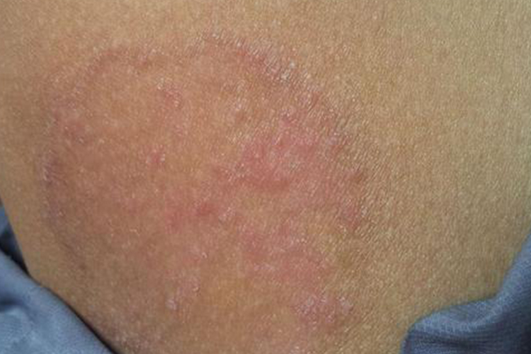 大腿内侧股癣图