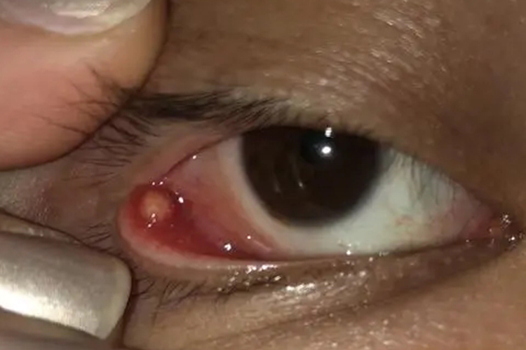 睑腺炎下眼皮颗粒图