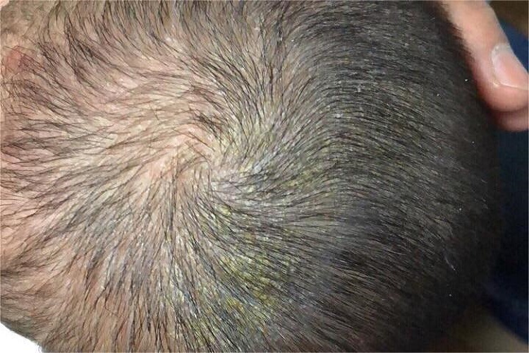 婴儿后脑勺干燥型湿疹图