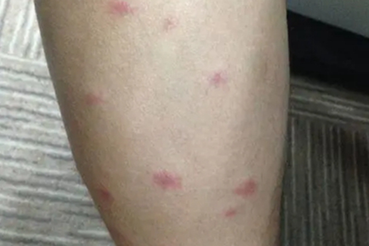 蠓虫叮咬引起的皮肤反应红斑图