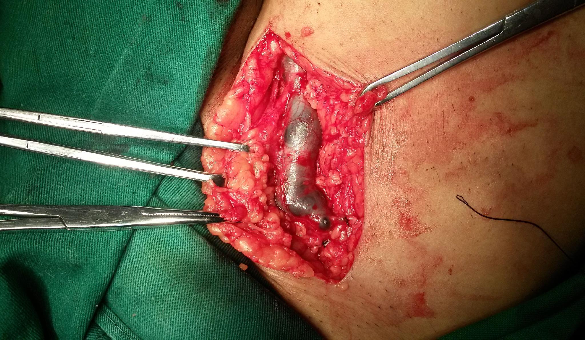 小隐静脉曲张手术图