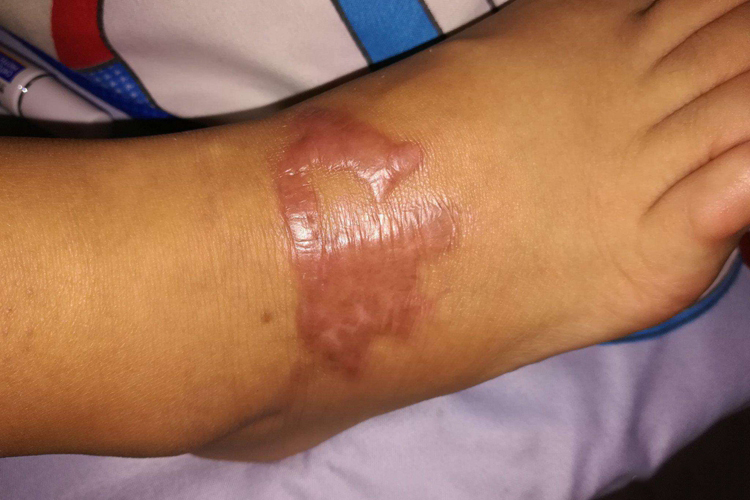 脚部增生性疤痕图