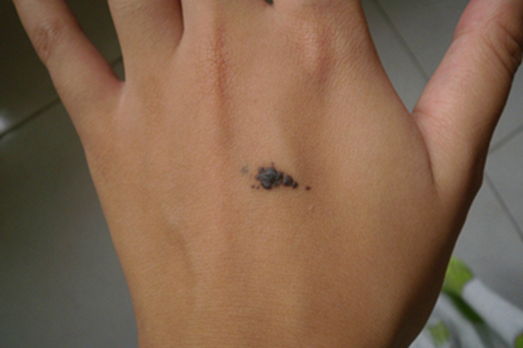 恶性黑色素瘤手背丘疹图 恶性黑色素瘤手背丘疹图