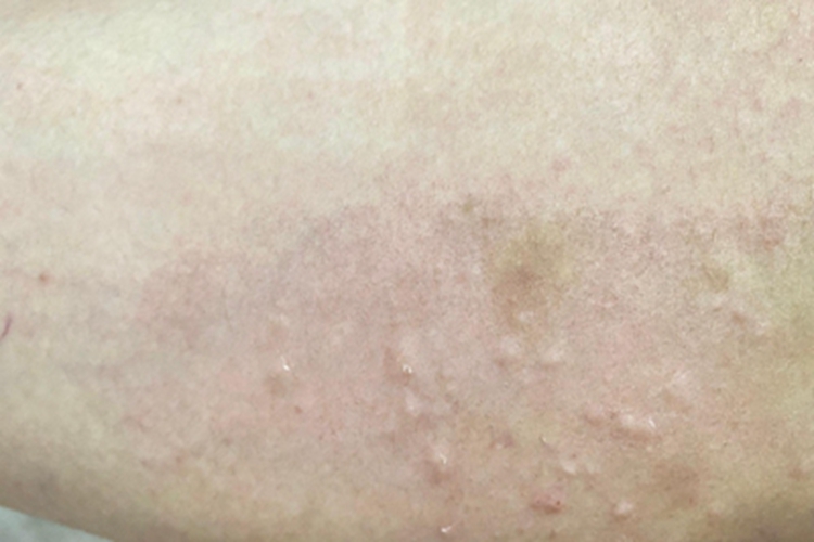 丘疹性荨麻疹大腿症状图 丘疹性荨麻疹大腿症状图
