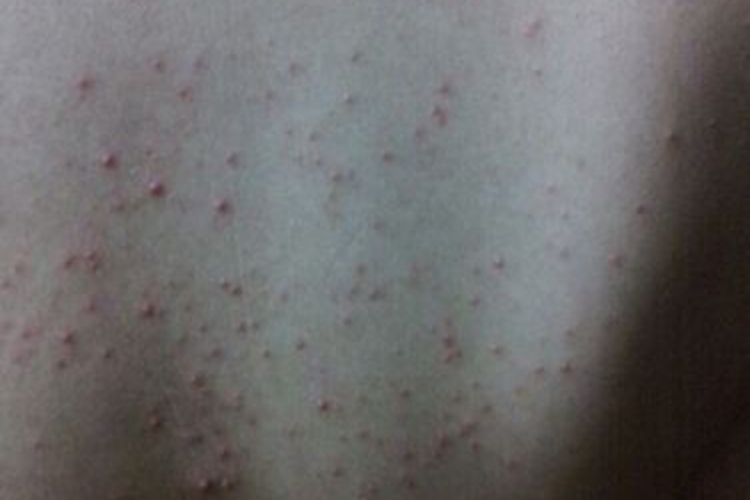 背上闭合性粉刺图