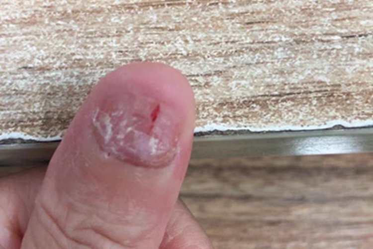 甲真菌病手指甲出血图