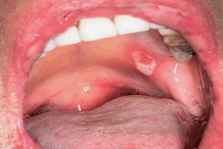 副肿瘤性天疱疮溃疡图