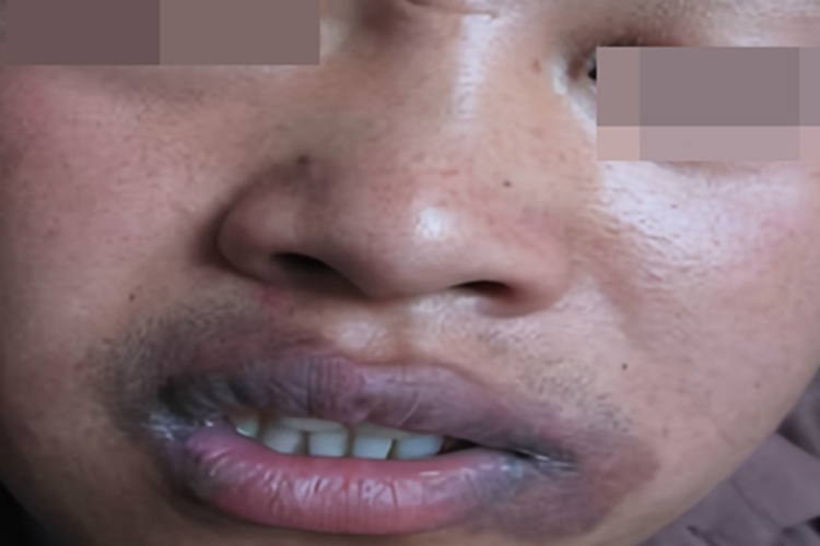 固定型药疹皮肤发黑图