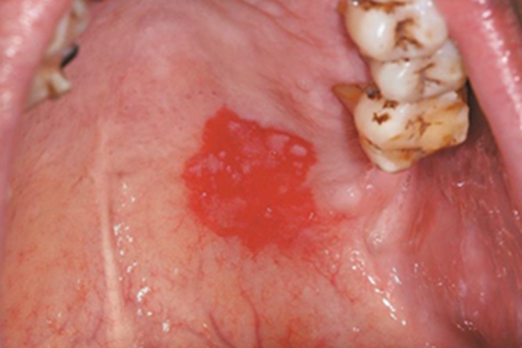 增殖性红斑口腔症状图