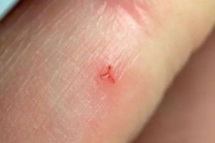 水蛭咬伤手指红肿图