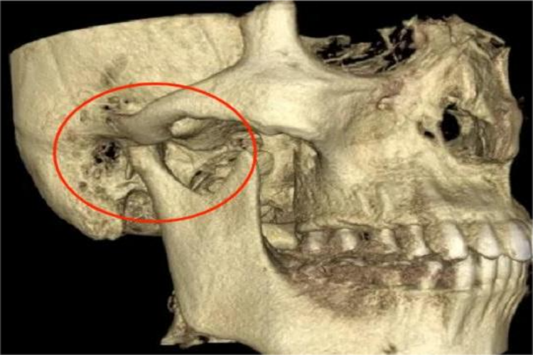 正常颌面部CT颞颌关节图 正常颌面部CT颞颌关节图