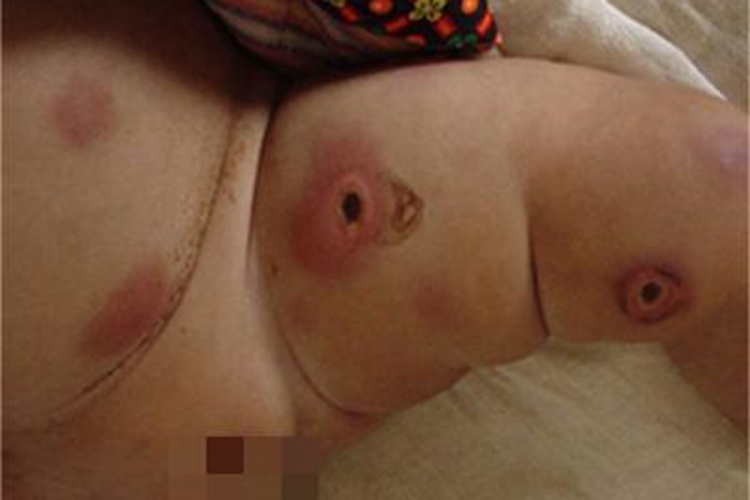 脓窝疮大腿红斑图 脓窝疮大腿红斑图