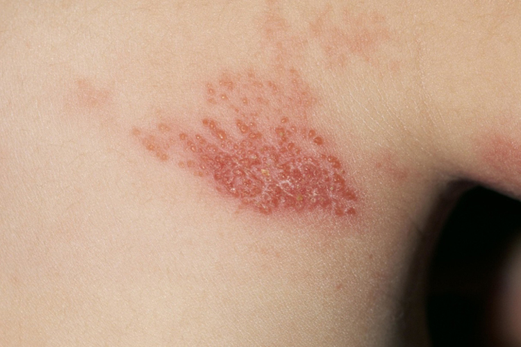 颈部带状疱疹水疱图