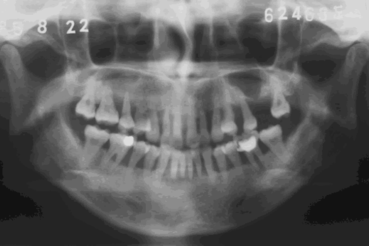 牙槽骨垂直型吸收图