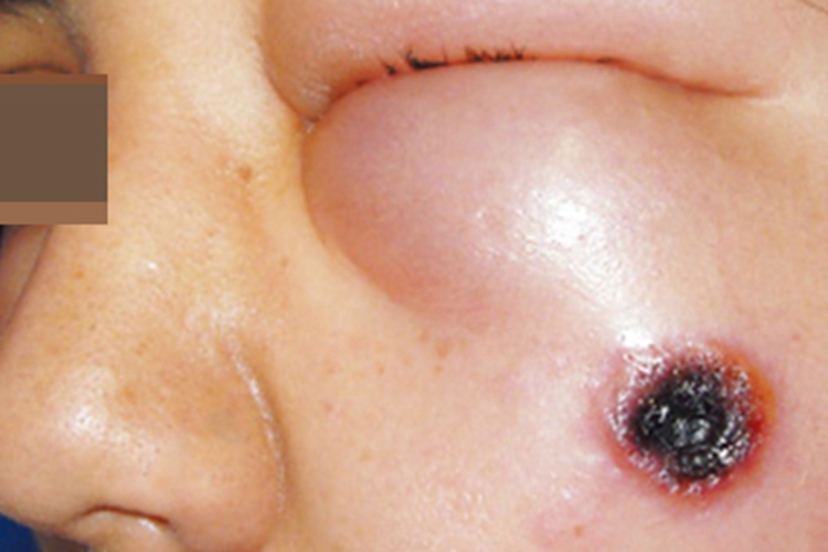 皮肤炭疽面部结痂图