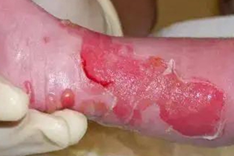 大疱性表皮松解症小腿水疱图 大疱性表皮松解症小腿水疱图