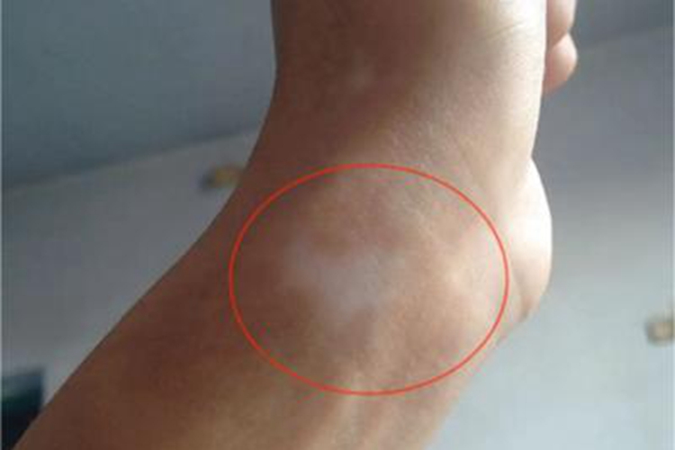 进展期节段型白癜风手腕白斑图