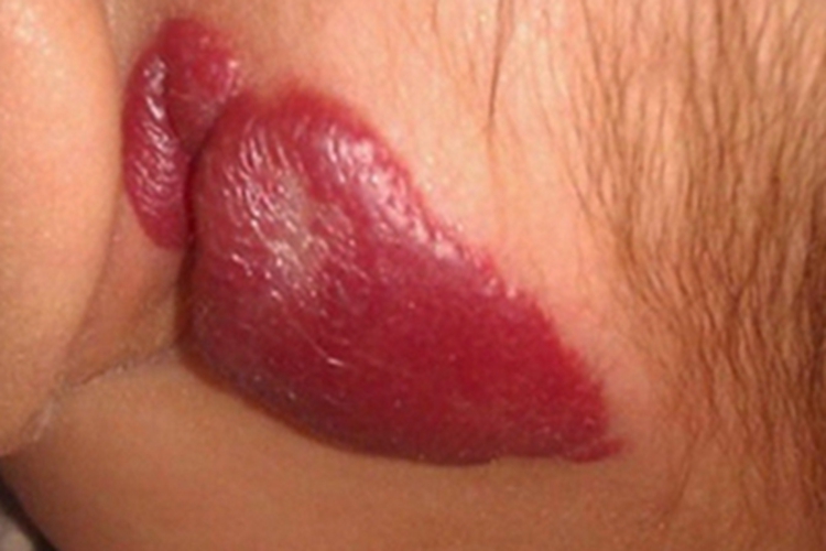 蔓状血管瘤耳朵后面有扁平疙瘩图 蔓状血管瘤耳朵后面有扁平疙瘩图