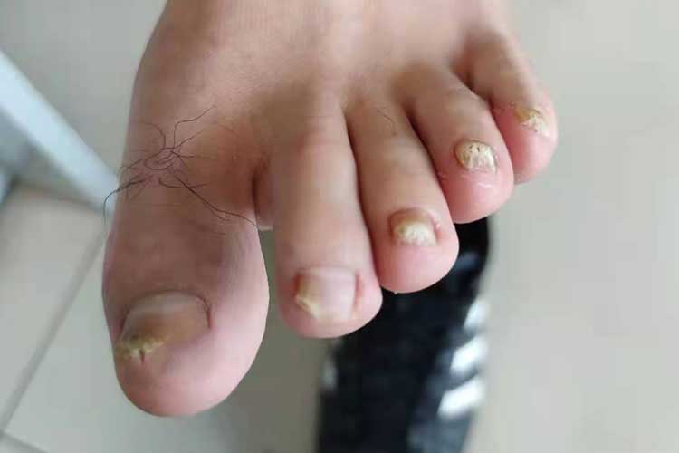 远端侧位甲下型灰指甲图 远端侧位甲下型灰指甲图